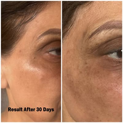 Pigmentation