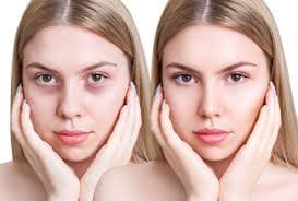 Dark Circles
