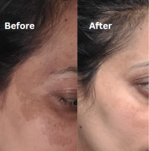 Luxyh Melasma, pigmentation and eyes combo – best skin care product