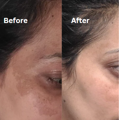 Luxyh Melasma, pigmentation and eyes combo – best skin care product